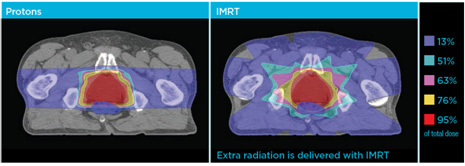 Proton therapy vs. IMRT